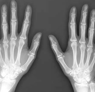 xrayhands