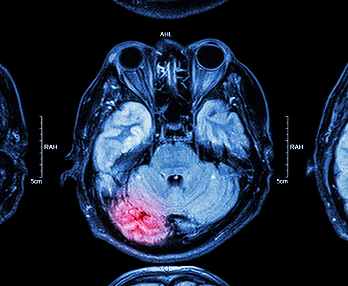 UTSA study: Newly developed neurons contribute to epileptic seizures